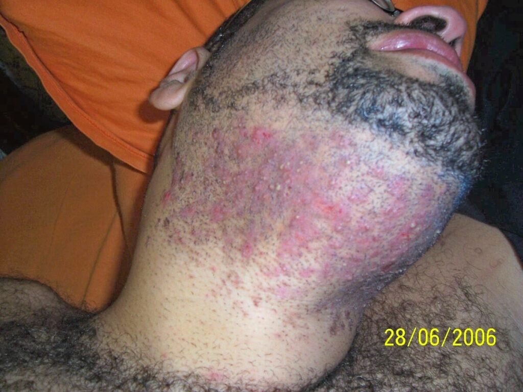 Primer plano lateral del cuello y la barbilla de Geovane Souza, que muestra una grave inflamación folicular. Su piel oscura presenta múltiples pústulas rojizas, heridas abiertas y cicatrices en la barba y la nuca, evidenciando la "carne viva" descrita en el texto. En la esquina inferior derecha, la fecha digital en amarillo indica: 28/06/2006.